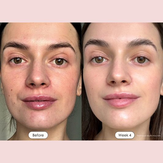 Before and week 4 facial skin comparison of a woman, showing clearer, smoother skin on the right side, set against a pale pink background with text labels.