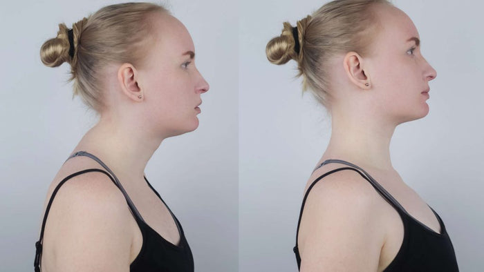 Forward head posture and neck hump diagram